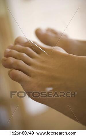 Close-up of a human foot receiving acupuncture treatment View Large Photo Image Stock Photo - Close-up of a human foot receiving acupuncture treatment. Fotosearch