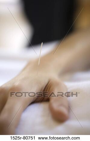 Close-up of a human hand receiving acupuncture treatment View Large Photo Image Stock Image - Close-up of a human hand receiving acupuncture treatment. Fotosearch