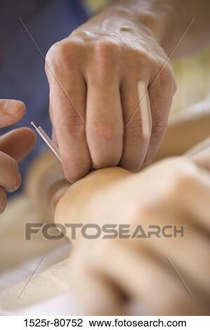 Close-up of a person receiving acupuncture treatment View Large Photo Image Stock Image - Close-up of a person receiving acupuncture treatment. Fotosearch