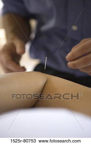 Close-up of a person receiving acupuncture treatment View Large Photo Image Stock Image - Close-up of a person receiving acupuncture treatment. Fotosearch