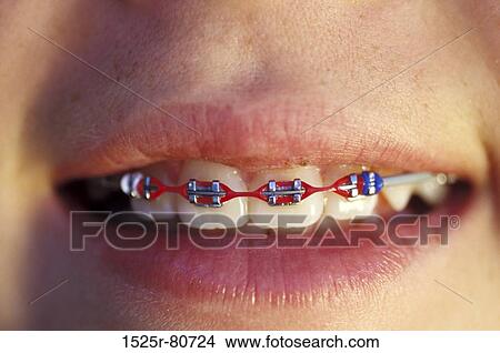 Close-up of a person's mouth with braces on his teeth View Large Photo Image Picture - Close-up of a person's mouth with braces on his teeth. Fotosearch