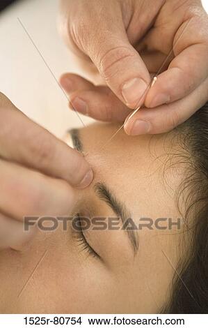 Close-up of a young woman receiving acupuncture treatment View Large Photo Image Picture - Close-up of a young woman receiving acupuncture treatment. Fotosearch