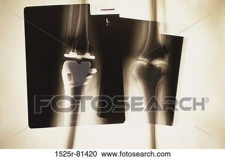 X-ray of a human leg with metal screws and rods View Large Photo Image Stock Image - X-ray of a human leg with metal screws and rods. Fotosearch