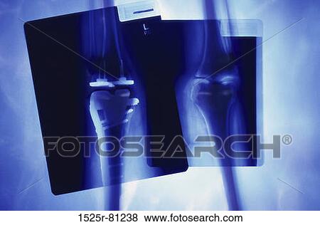 Stock Photo - X-ray of a human leg with metal screws and rods. Fotosearch