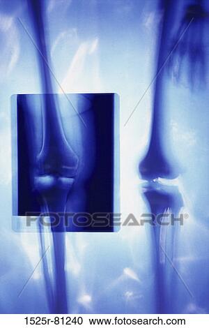 X-ray of a pair of human legs View Large Photo Image Stock Image - X-ray of a pair of human legs. Fotosearch
