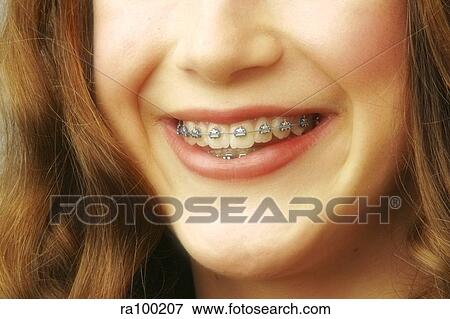 braces View Large Photo Image Stock Photo - braces. Fotosearch