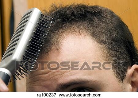 Stock Photo - Hair loss. Fotosearch