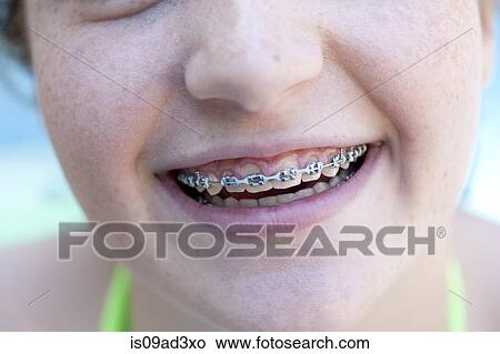Girl with dental braces View Large Photo Image Picture - Girl with dental braces. Fotosearch