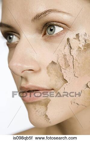 Stock Image - Woman with cracked and peeling skin. Fotosearch