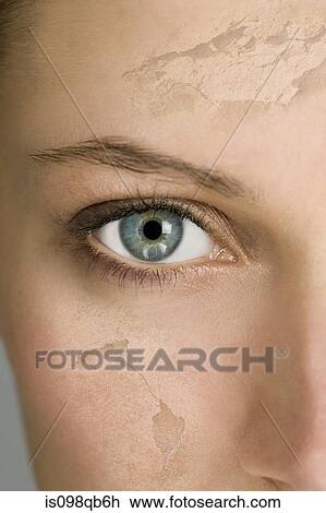 Stock Image - Woman with cracked and peeling skin. Fotosearch