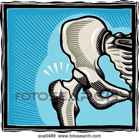 a broken hip bone View Large Illustration Stock Illustration - a broken hip bone. Fotosearch