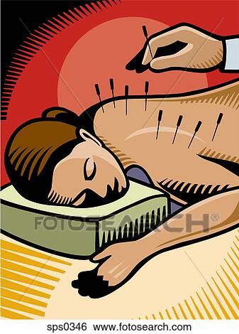 Acupuncture carried out on a woman View Large Illustration Stock Illustration - Acupuncture carried out on a woman. Fotosearch