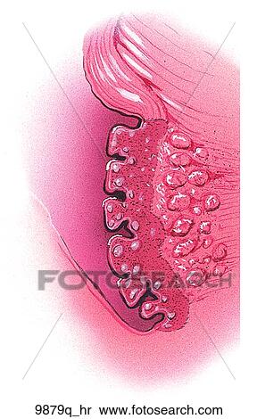 舌 扁桃腺 Unlabeled 圖解或向量圖 9879q Hr Fotosearch