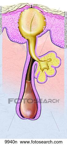 Acne Closed Comedo (Whitehead) Unlabeled View Large Illustration Stock Illustration - Acne Closed Comedo (Whitehead) Unlabeled. Fotosearch