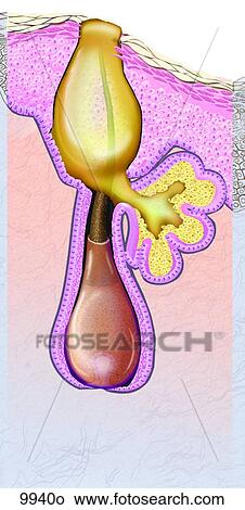 Acne Open Comedo (Blackhead) Unlabeled View Large Illustration Stock Illustration - Acne Open Comedo (Blackhead) Unlabeled. Fotosearch