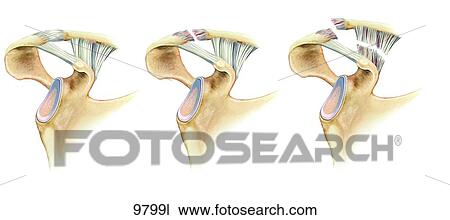 Acromioclavicular Separation Unlabeled View Large Illustration Drawing - Acromioclavicular Separation Unlabeled. Fotosearch