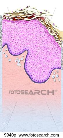 Stock Illustration - Actinic Keratosis (Solar Keratosis) Unlabeled. Fotosearch