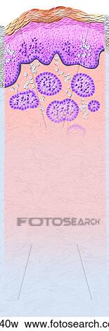 Basal Cell Carcinoma Unlabeled View Large Illustration Stock Illustration - Basal Cell Carcinoma Unlabeled. Fotosearch