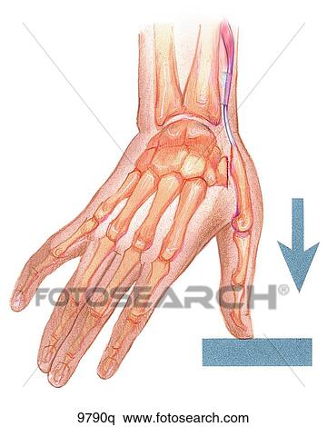 Stock Illustration - Bennett's Fracture Unlabeled. Fotosearch
