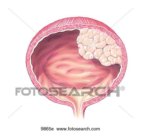 Рак мочевого пузыря. Фиброма мочевого пузыря. Доброкачественная опухоль мочевого пузыря.