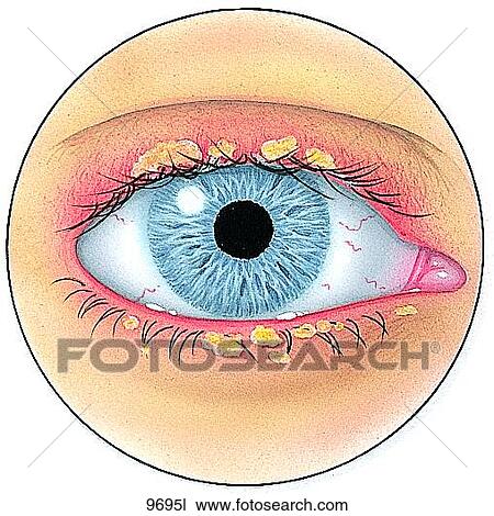 Blepharitis Unlabeled View Large Illustration Drawing - Blepharitis Unlabeled. Fotosearch