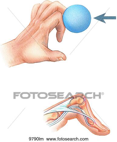 Stock Illustration - Boutonniere Deformity Unlabeled. Fotosearch