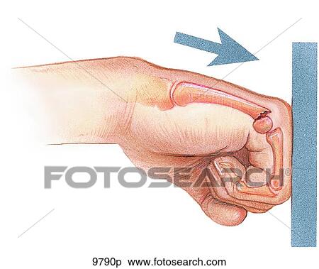 Stock Illustration - Boxer's Fracture Unlabeled. Fotosearch