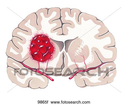 Brain with Hemorrhage Unlabeled View Large Illustration Clip Art - Brain with Hemorrhage Unlabeled. Fotosearch