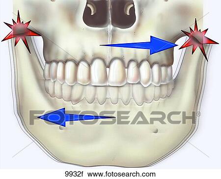 Burxism/Clenching Unlabeled View Large Illustration Clip Art - Burxism/Clenching Unlabeled. Fotosearch