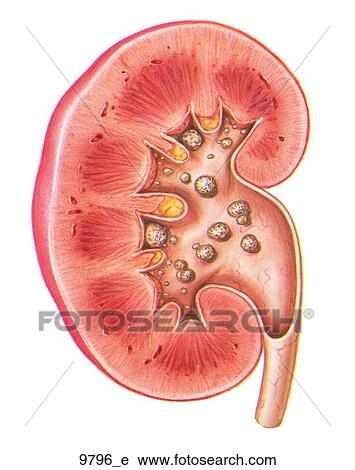 Calcium Stones in Kidney Unlabeled View Large Illustration Clip Art - Calcium Stones in Kidney Unlabeled. Fotosearch