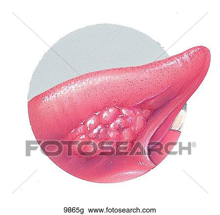 Cancer of the Tongue Unlabeled View Large Illustration Drawing - Cancer of the Tongue Unlabeled. Fotosearch