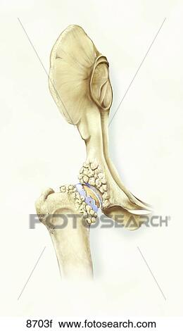 Clip Art - Canine Hip Dysplasia and Osteoarthritis Unlabeled. Fotosearch