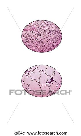 Close up picture of healthy alveoli and alveoli damaged by cigarette smoke. View Large Illustration Clipart - Close up picture of healthy alveoli and alveoli damaged by cigarette smoke.. Fotosearch
