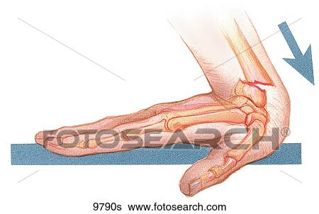 Colles Fracture Unlabeled View Large Illustration Stock Illustration - Colles Fracture Unlabeled. Fotosearch