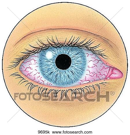 Conjunctivitis Unlabeled View Large Illustration Drawing - Conjunctivitis Unlabeled. Fotosearch