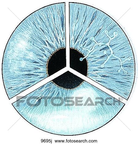Corneal Ulcers Unlabeled View Large Illustration Drawing - Corneal Ulcers Unlabeled. Fotosearch