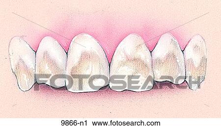 Dental Enamel Hypoplasia Unlabeled View Large Illustration Clip Art - Dental Enamel Hypoplasia Unlabeled. Fotosearch