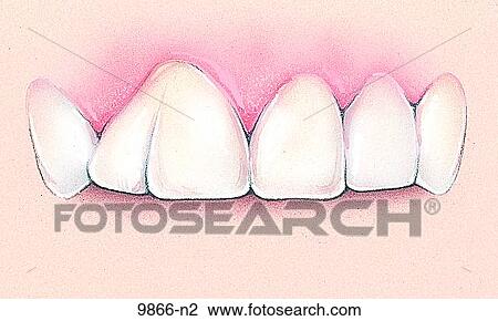 Dental Fusion Unlabeled View Large Illustration Drawing - Dental Fusion Unlabeled. Fotosearch