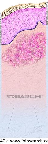 Dermatofibroma Unlabeled View Large Illustration Stock Illustration - Dermatofibroma Unlabeled. Fotosearch