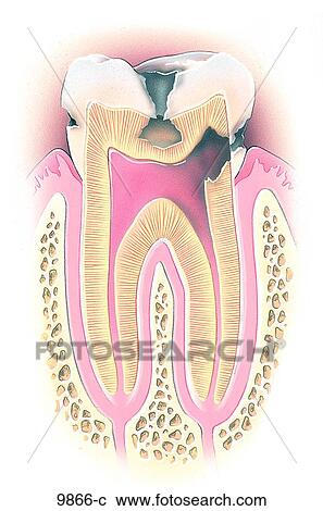 Drei Stadien Von Dentale Karies Unlabeled Clipart 9866 C Fotosearch