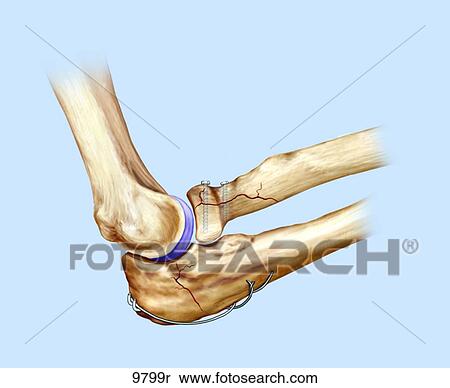 Elbow Radial Head Fracture with Fixture Unlabeled View Large Illustration Stock Illustration - Elbow Radial Head Fracture with Fixture Unlabeled. Fotosearch