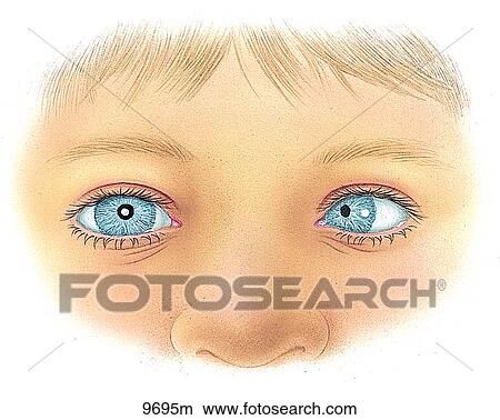 Esotropia Unlabeled View Large Illustration Stock Illustration - Esotropia Unlabeled. Fotosearch