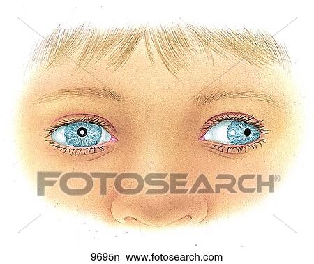 Stock Illustration - Exotropia Unlabeled. Fotosearch
