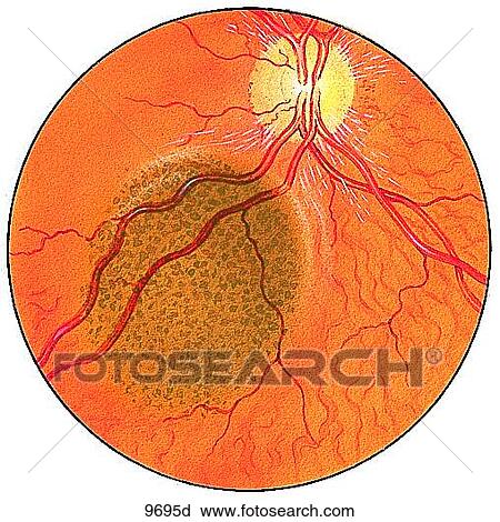 Eye Melanoma Unlabeled View Large Illustration Clip Art - Eye Melanoma Unlabeled. Fotosearch