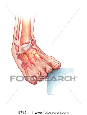 Foot with Malleolus Fractures Unlabeled View Large Illustration Drawing - Foot with Malleolus Fractures Unlabeled. Fotosearch