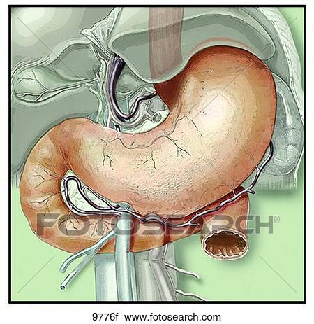 Clip Art - Gastric Surgery Icon Unlabeled. Fotosearch