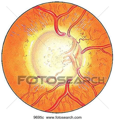 Clipart - Glaucoma Unlabeled. Fotosearch