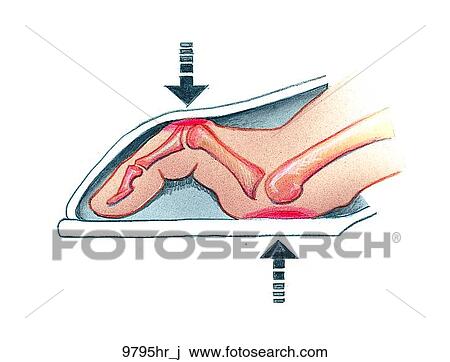 Hammertoe Unlabeled View Large Illustration Drawing - Hammertoe Unlabeled. Fotosearch