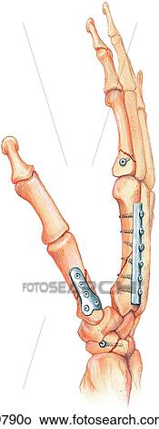 Hand Showing Fractures with Fixations Unlabeled View Large Illustration Stock Illustration - Hand Showing Fractures with Fixations Unlabeled. Fotosearch