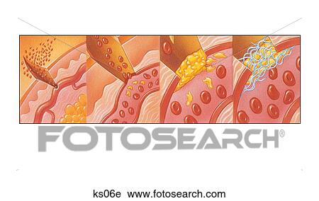 How cuts heal. Shows 4 steps from a cut making a hole in the blood vessel to fibrin repairing the hole. View Large Illustration Clip Art - How cuts heal. Shows 4 steps from a cut making a hole in the blood vessel to fibrin repairing the hole.. Fotosearch